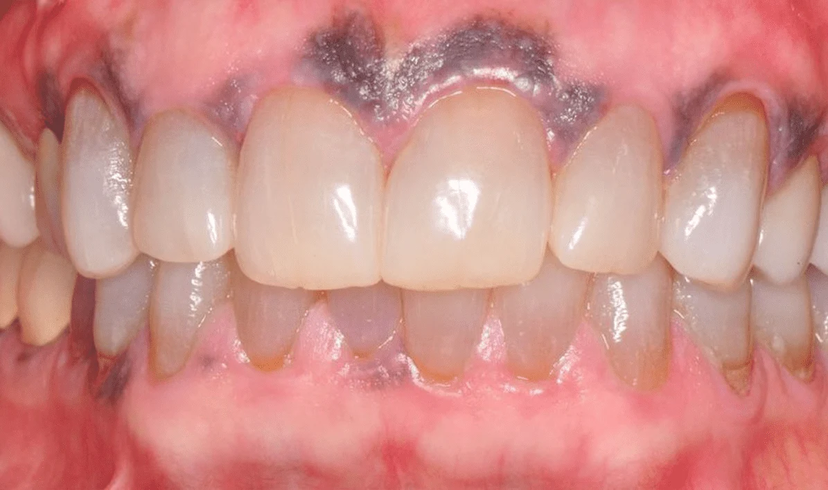 Before and After images for Depigmentation of Gingiva
