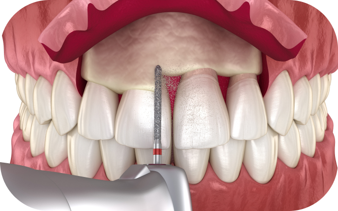 Diagram showing gumline lifted to allow for lengthening of gumline