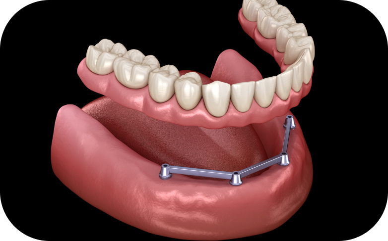 Diagram showing inserting connective tissue into gumline