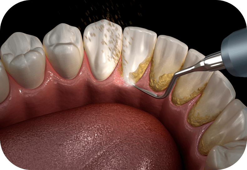 Diagram of scaling tool cleaning teeth