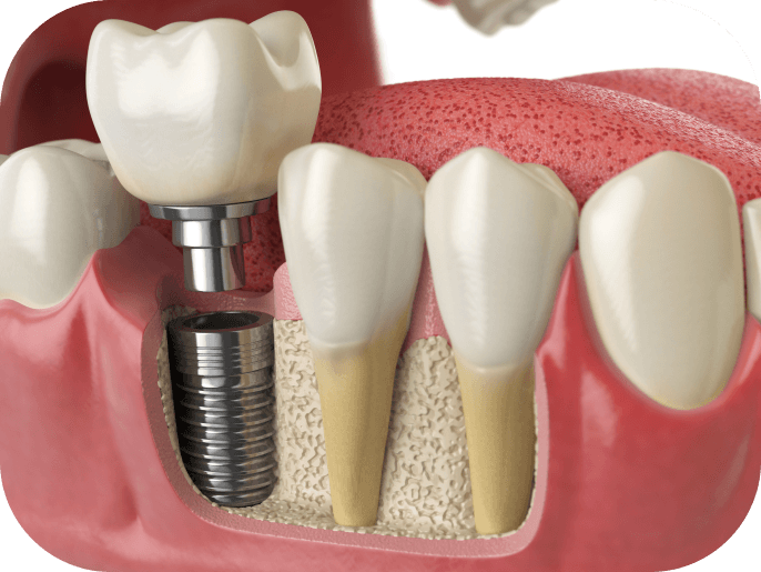 Single Tooth Dental Implants diagram