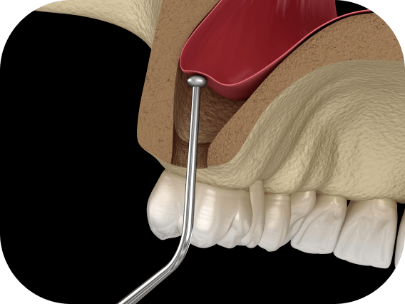 Sinus Lift graphic