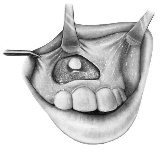 diagram showing impacted teeth treatment