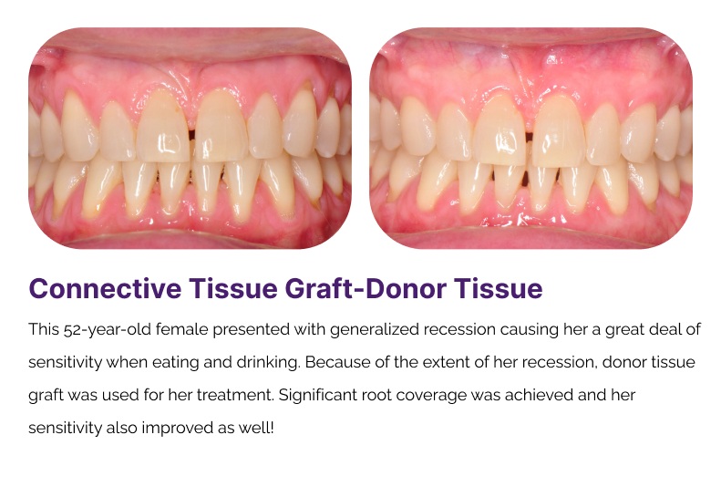 Gum Graphting Before and After