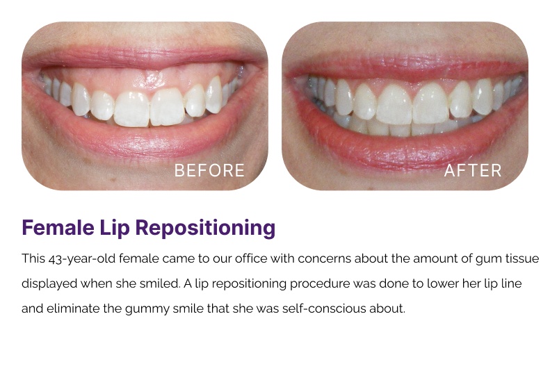 Lip Repositioning | Periodontist in Greensboro, NC