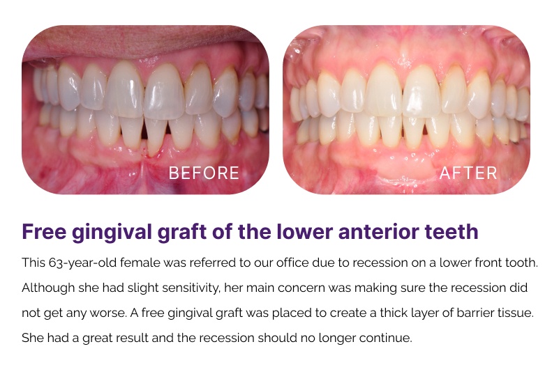 Gum Graphting Before and After