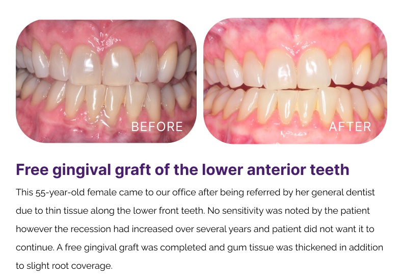 Gum Graphting Before and After