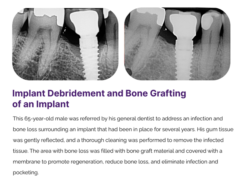 Gum Graphting Before and After